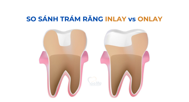 trám răng inlay vs trám răng onlay