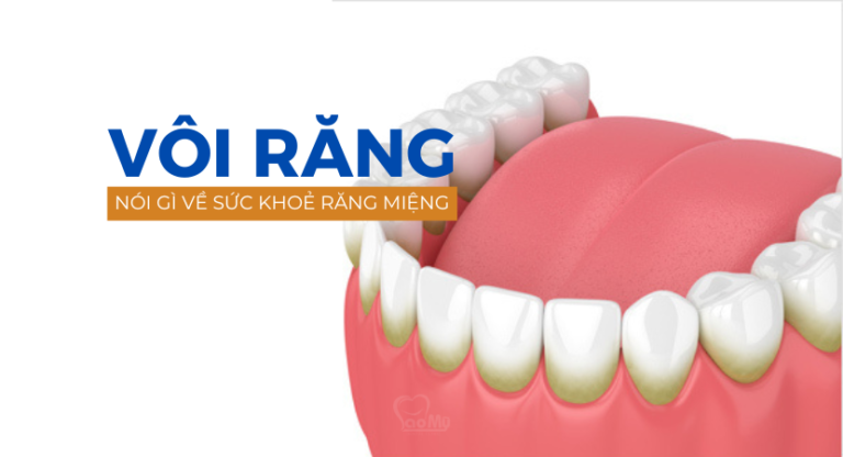 vôi răng và sức khoẻ răng miệng