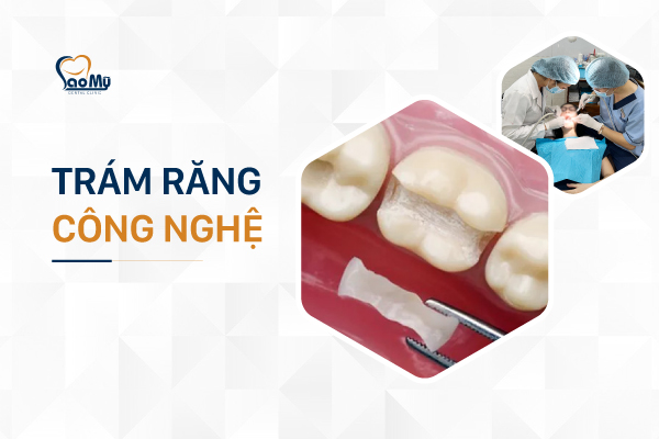 trám răng công nghệ