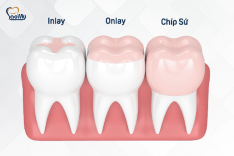 Nha khoa trám răng inlay onlay uy tín phú nhuận Nha khoa Sao Mỹ