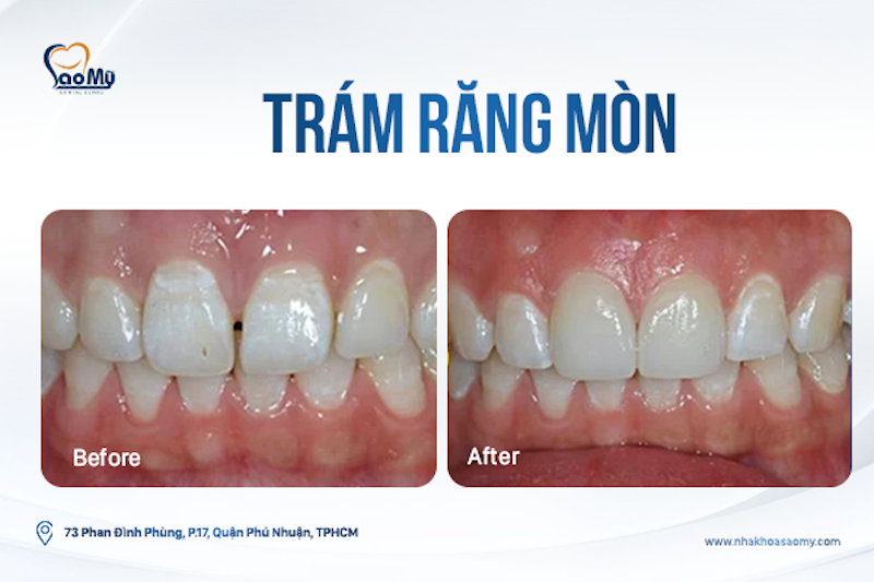 Trám răng bị mòn có tốt không - Nha khoa Sao Mỹ ở Phú Nhuận