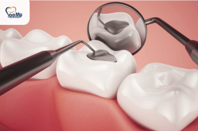 Trám răng Composite uy tín tại Phú Nhuận - Nha khoa Sao Mỹ
