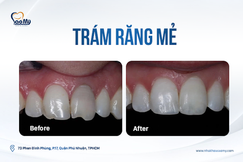 Trám răng mẻ vỡ có được không.- Nha khoa Sao Mỹ Phú Nhuận