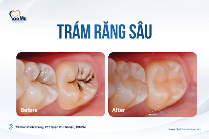 Trám răng sâu ở đâu uy tín - Nha khoa Sao Mỹ Phú Nhuận