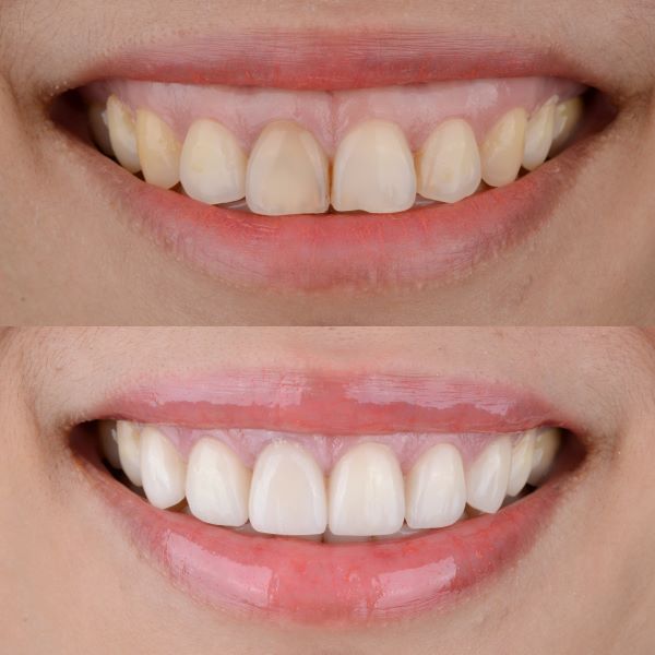 kết quả cắt lợi tại Nha Khoa Sao Mỹ