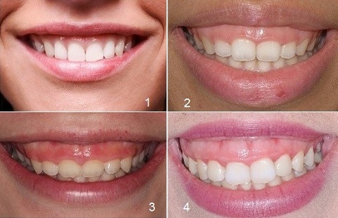 Nguyên nhân gây cười hở lợi