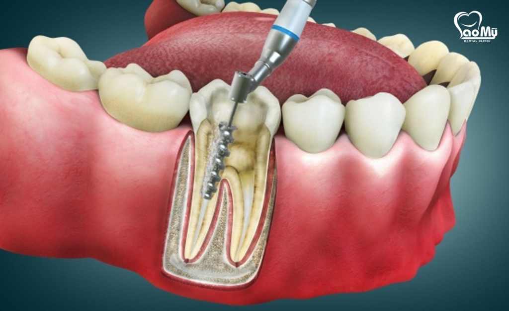 nguyên nhân lấy tủy rồi vẫn đau