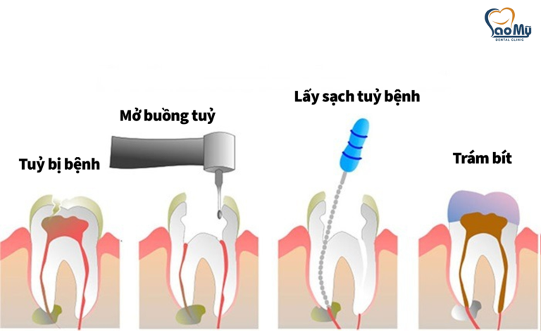 quy-trinh-lay-tuy-rang