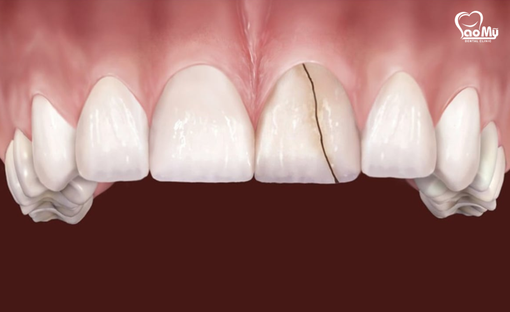răng bị nứt vỡ sau khi lấy tủy