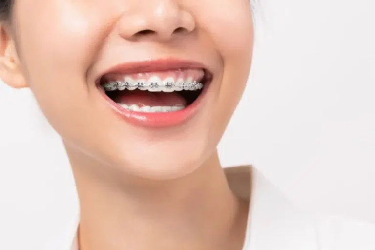 Niềng răng có hết cười hở lợi không?