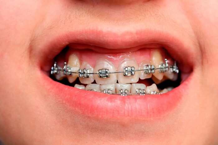 niềng răng có hết hở lợi không