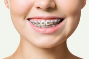 Niềng răng trả góp