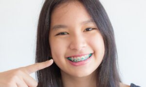 Niềng răng trẻ em sớm
