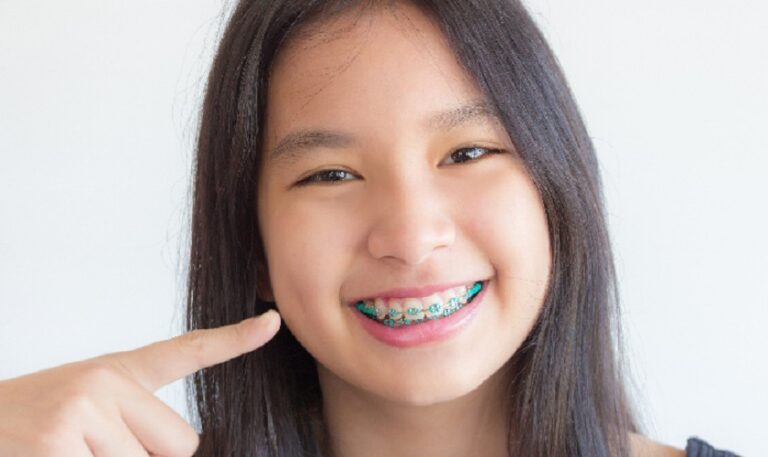 Niềng răng trẻ em sớm